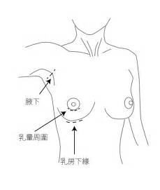 果凍矽膠隆乳手術過程