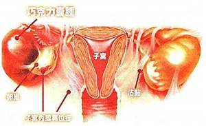 單側卵巢巧克力囊腫