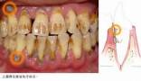 牙齒浮腫吃什麼如何治療